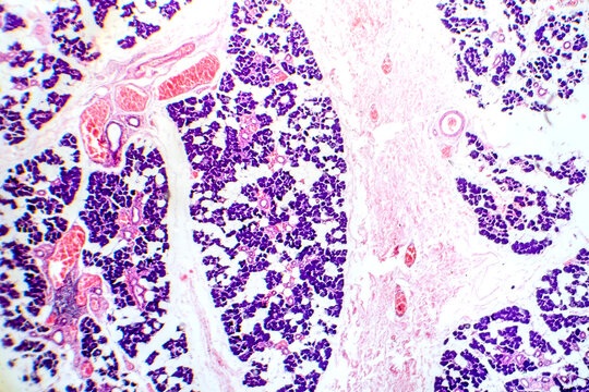 Mixed parotid tumor, photomicrograph showing epithelial and myoepithelial cell components within chondromyxoid stroma, typical of pleomorphic adenoma.
