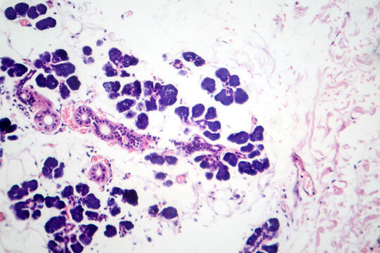 Mixed parotid tumor, photomicrograph showing epithelial and myoepithelial cell components within chondromyxoid stroma, typical of pleomorphic adenoma.