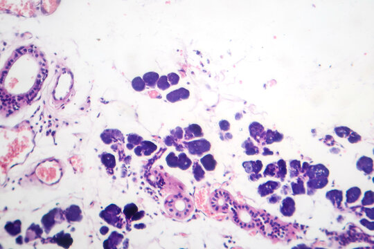 Mixed parotid tumor, photomicrograph showing epithelial and myoepithelial cell components within chondromyxoid stroma, typical of pleomorphic adenoma.