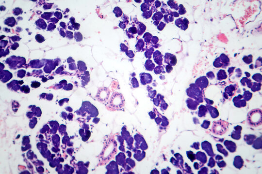 Mixed parotid tumor, photomicrograph showing epithelial and myoepithelial cell components within chondromyxoid stroma, typical of pleomorphic adenoma.