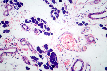 Mixed parotid tumor, photomicrograph showing epithelial and myoepithelial cell components within...