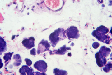 Mixed parotid tumor, photomicrograph showing epithelial and myoepithelial cell components within...