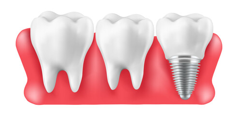 Illustration of tooth implantation, tooth restoration, Mesh gradient wes