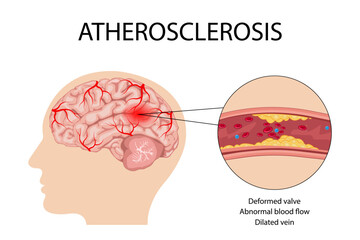 Anatomy of a person with atherosclerotic stroke. Atherosclerosis of the blood vessels of the brain