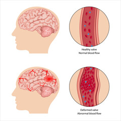 cerebrovascular accident, stroke, or cerebral infarction with a thrombus or blood clot