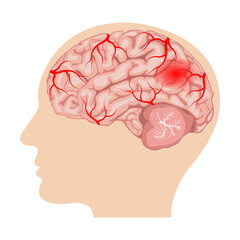 hemorrhagic stroke. intracerebral and subarachnoid hemorrhage. human brain with blood vessels and hematoma
