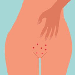 Vaginal Infection woman with genital itching  illustration and vector