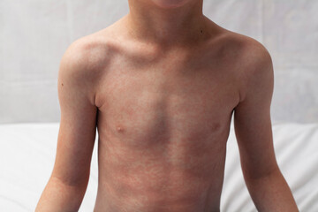Close-up of a boy's belly with a rash from rubella, allergic reaction or atopic dermatitis