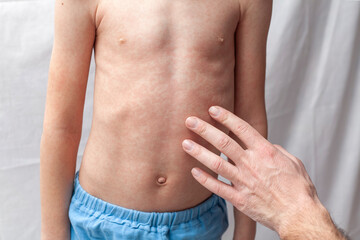 The doctor examines the boy's stomach. The child has a red rash on his stomach from an allergy or scarlet fever.