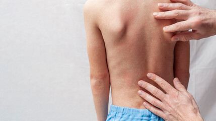 The doctor examines the boy's back. The child has a red rash on his back from an allergy or rubella.