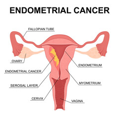 Endometrial Cancer. Vector Uterus Cross Section with Labeled Anatomy. Uterine cancer. 