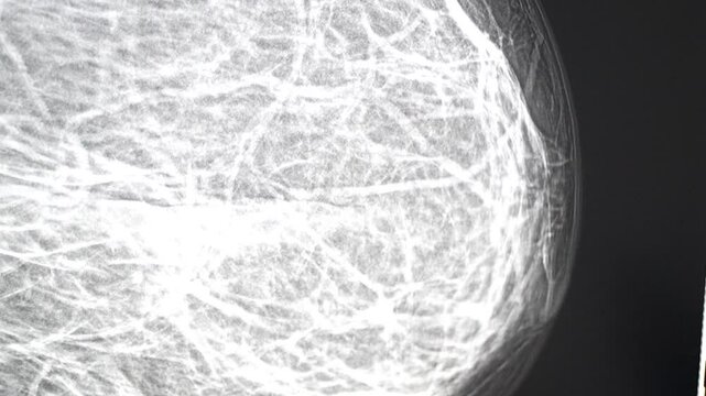 Mammography of the breast tissue. X-ray Digital Mammogram or mammography CC and MLO of the breast in women for screening Breast cancer. Mammogram used in diagnosis.