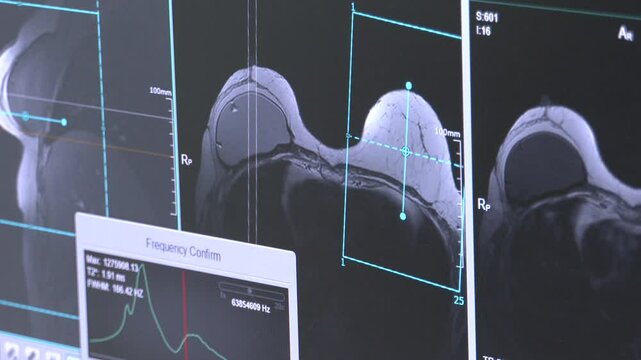 Breast MRI or magnetic resonance imaging of Breast both side with breast silicone implant in women for screening breast cancer
