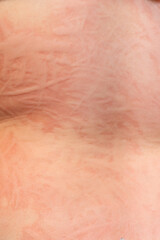 Dermographism skin reaction observed on human skin during a tactile stimulus at an indoor location