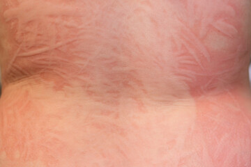 Understanding dermographism on skin, showcasing raised welts and patterns caused by skin irritation