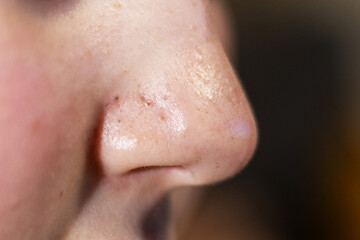 Close-up view of skin texture showing blackheads on the nose, highlighting facial care challenges...