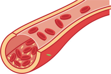 28 Medical illustration, cross-section of blood vessels, red blood cells, cholesterol buildup, arterial plaque, circulatory system, atherosclerosis progression, scientific diagram, detailed anatomy, c