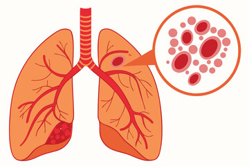 54 Medical illustration, human lungs, microscopic view of blood vessel, cancer cells, 3D rendering, detailed anatomy, orange and red color palette, scientific diagram, cellular structure, medical text