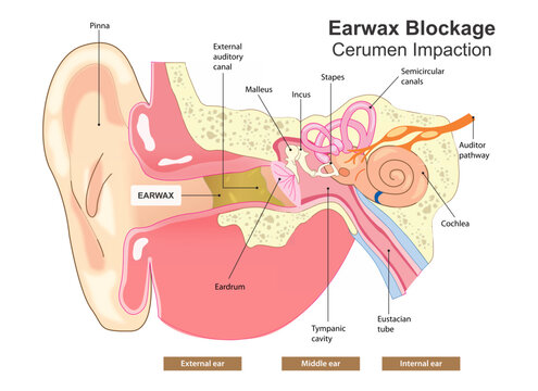 Earwax Blockage Cerumen Impaction Illustration