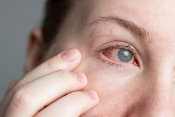 Close up of female face with one red eye suffering from infection conjunctivitis