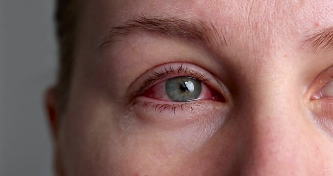 Close up of female face with one red eye suffering from infection conjunctivitis