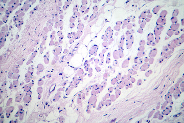 Skeletal muscle atrophy, photomicrograph showing decreased fiber size with increased spacing...