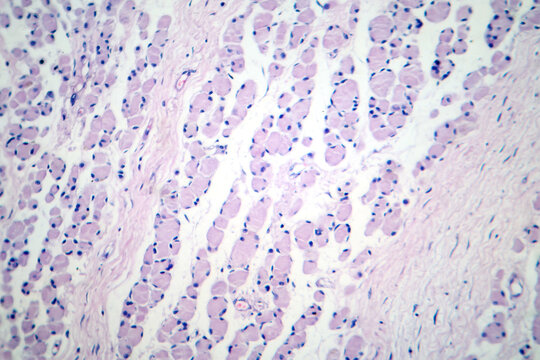 Skeletal muscle atrophy, photomicrograph showing decreased fiber size with increased spacing between them, reduced myofibrils, increased endomysial connective tissue with fatty infiltration
