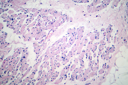 Skeletal muscle atrophy, photomicrograph showing decreased fiber size with increased spacing between them, reduced myofibrils, increased endomysial connective tissue with fatty infiltration