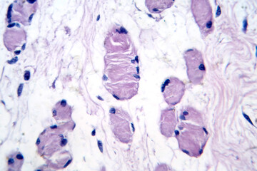 Skeletal muscle atrophy, photomicrograph showing decreased fiber size with increased spacing...