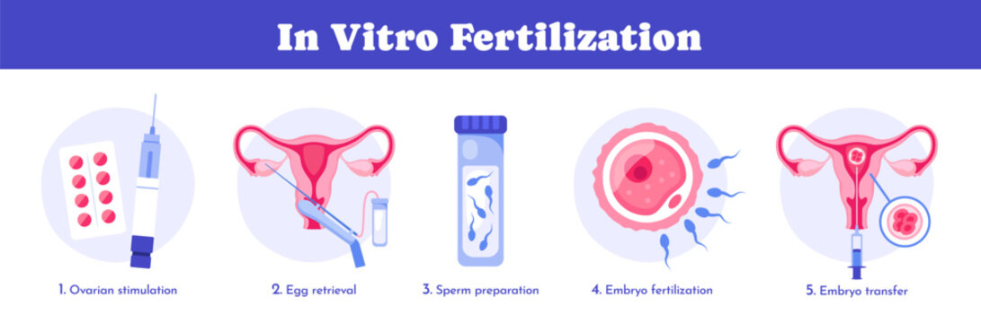 In vitro fertilization. Medical poster with Embryo development stages and transfer. Detailed infographic showing laboratory fertilization. Flat vector illustration collection isolated on background