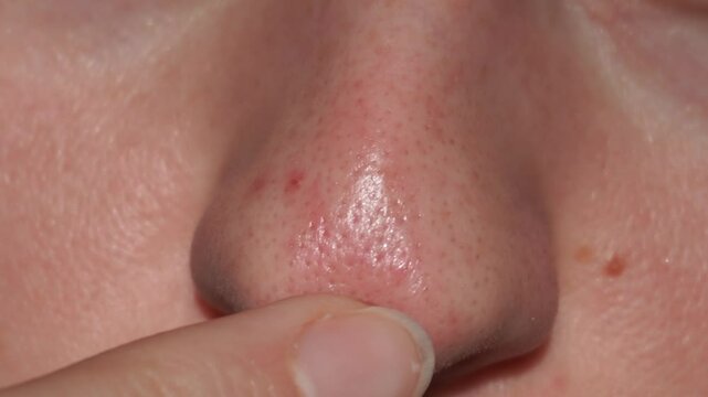 Macro video of oily nose with enlarged pores and finger gently touching the skin. Slow subtle movement, skin shine and visible texture. Ideal for skincare, dermatology, and cosmetic content.