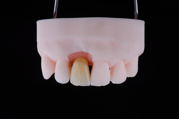 Mirror copy of central maxillary incisor, zirconia crown on titanium abutment fixed on printed model