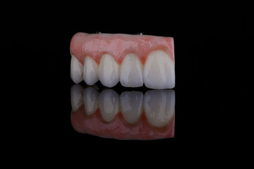 Naturally dental bridge with artificial gum made of zirconium for fixation to frontal upper teeth.
