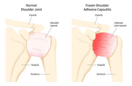 Anatomy of Frozen shoulder or Adhesive capsulitis disease causes pain and stiffness