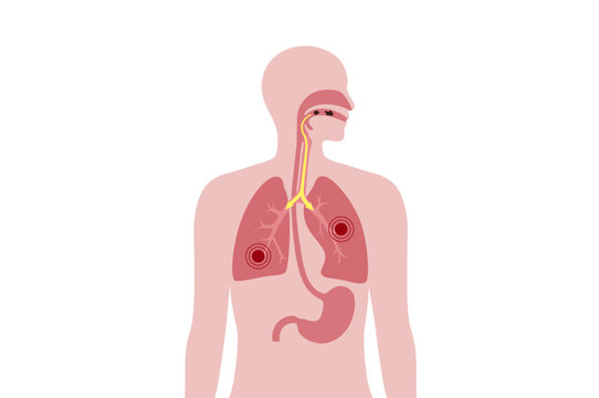 Common Cold Windpipe รูปภาพWindpipe – เลือกดูภาพถ่ายสต็อก เวกเตอร์ และวิดีโอ3,348 | Adobe Stock