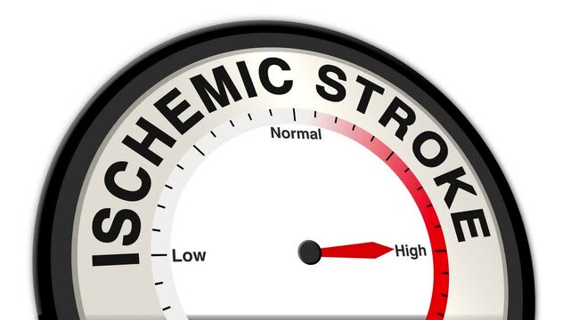 Ischemic Stroke text or word shown with a barometer or tachometer-style gauge, representing varying levels of severity in the blockage of blood flow to the brain and its impact on brain function