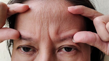 Close up the forehead lines and scar, Flabbiness and wrinkle, swelling and ptosis, Flabby skin and dark spots on the face, health care and beauty concept.