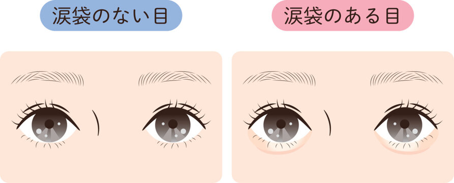 涙袋あり・なしビフォーアフター｜美容・メイク・整形比較