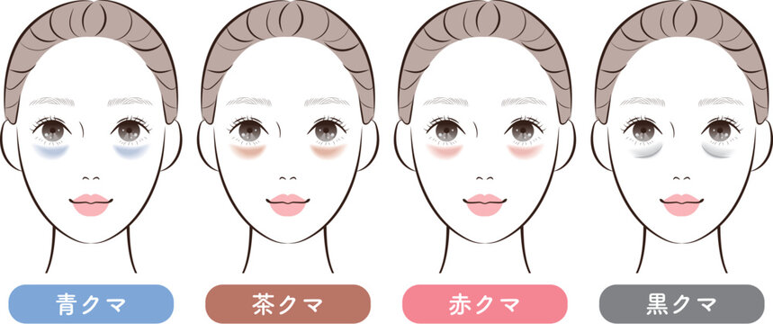 目の下のクマ4タイプ比較｜美容・スキンケア解説用イラスト