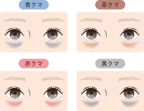 目の下のクマ4タイプ比較｜美容・スキンケア解説用イラスト