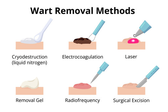 Wart removal methods showing cryodestruction, electrocoagulation, laser, removal gel, radiofrequency and surgical excision