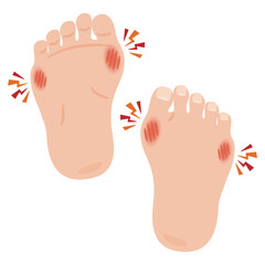 外反母趾のイラスト