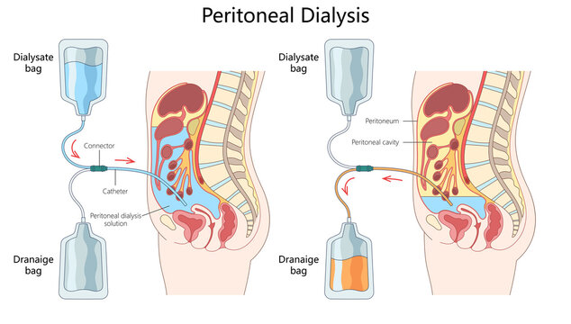 how peritoneal dialysis works, including placement of catheter, dialysate inflow, and drainage from the peritoneal cavity diagram hand drawn schematic raster illustration. Medical science educational