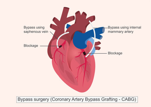 Bypass surgery (Coronary Artery Bypass Grafting or CABG)