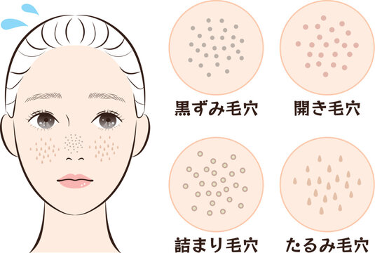 鼻の毛穴トラブル4種類セット｜たるみ・詰まり・黒ずみ・開き毛穴のイラスト素材