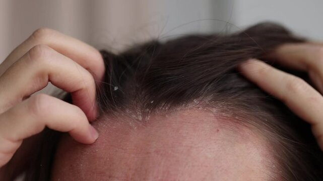 Woman scratching her head because of dandruff. 4K, slow motion.