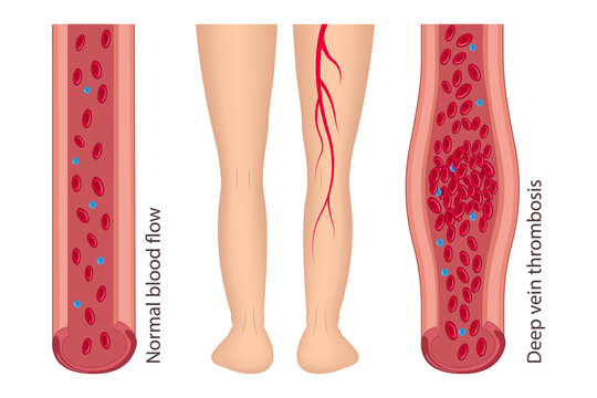 Medical diagram of deep vein thrombosis in the leg area. Illustration of blood flow disorder