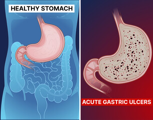 Healthy stomach. Unhealthy stomach. Acute gastric ulcers, gastritis. Gastroesophageal reflux disease. Peptic ulcer disease. Digestive system. Humans' anatomical structure. Medical illustration, vector