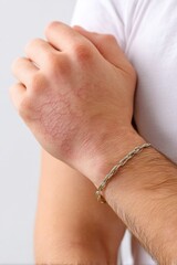 A close-up of a hand showing subtle shingles rash from Varicella-Zoster Virus, highlighting early skin irritation.