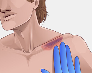 Broken collarbone. Symptoms of a broken collarbone. Healthcare illustration. Vector illustration.